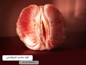 افراد مناسب لابیاپلاستی