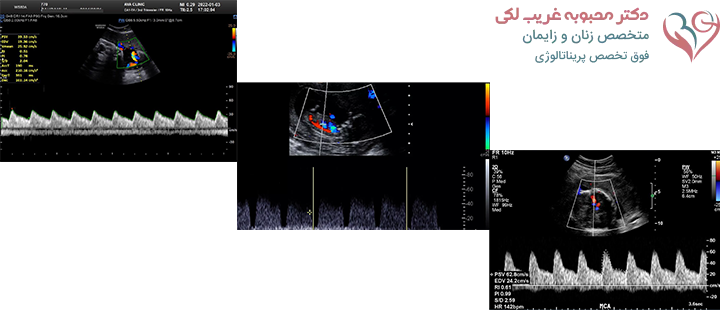 آشنایی با سونوگرافی داپلر در بارداری