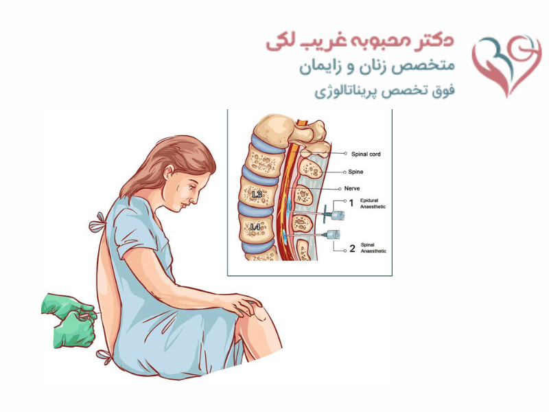 تزریق اپیدورال