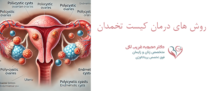 روش های درمان کیست تخمدان 