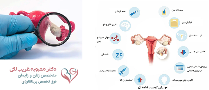 همه چیز درباره کیست تخمدان 