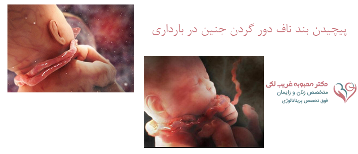 درباره پیچیدن بند ناف دور گردن جنین در بارداری