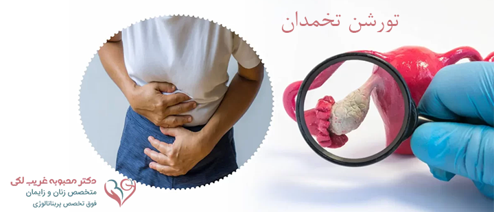 تورشن تخمدان چیست؟