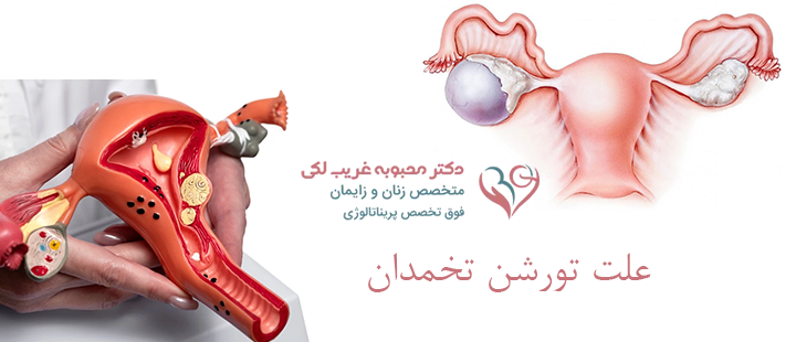 علت تورشن تخمدان 