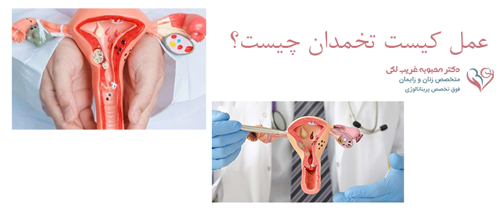 عمل کیست تخمدان چیست؟